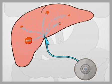 Liver with pump attached.
