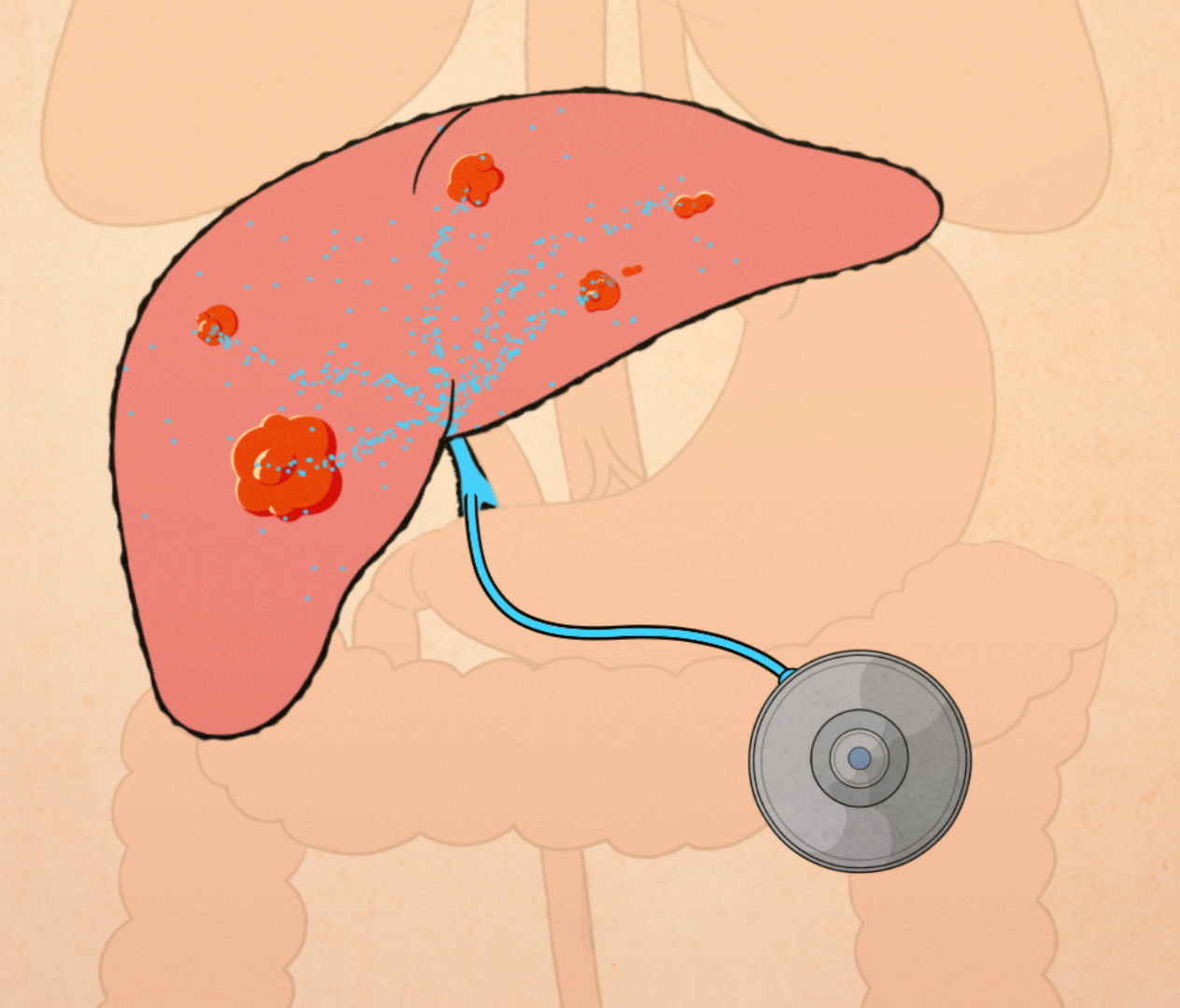 Illustration of liver and pump.