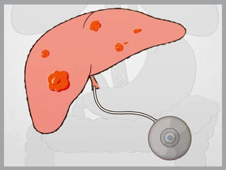Intera pump illustration.